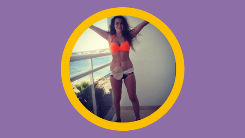 Anna in swim suit with stoma, arms outstretched
